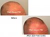 Click image for larger version

Name:	Hair Transplant Slides copy17.003.jpg

Size:	11.4 KB
ID:	44123