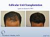22-year-old male before and after 2507 grafts to the frontal third of his scalp by Dr. Carlos K. Wesley.  A video montage of his transformation can...