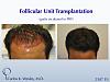22-year-old male before and after 2507 grafts to the frontal third of his scalp by Dr. Carlos K. Wesley.  A video montage of his transformation can...