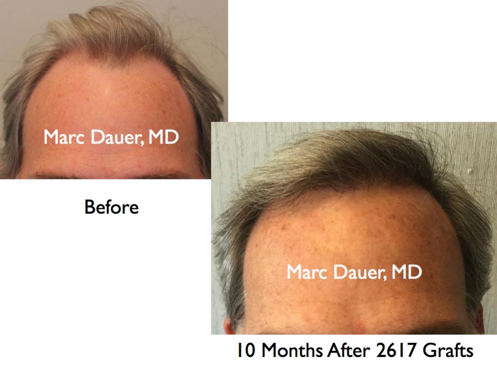 Click image for larger version

Name:	Hair Transplant Slides2.321.jpg

Size:	64.2 KB
ID:	35729