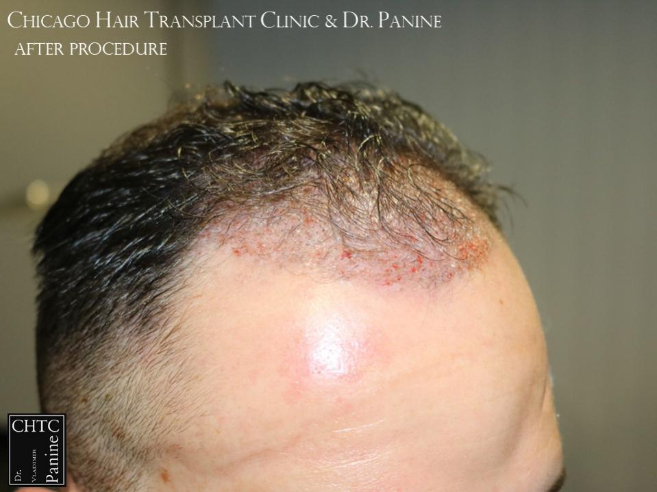 PANINE, MD FUE Hair Transplant Results