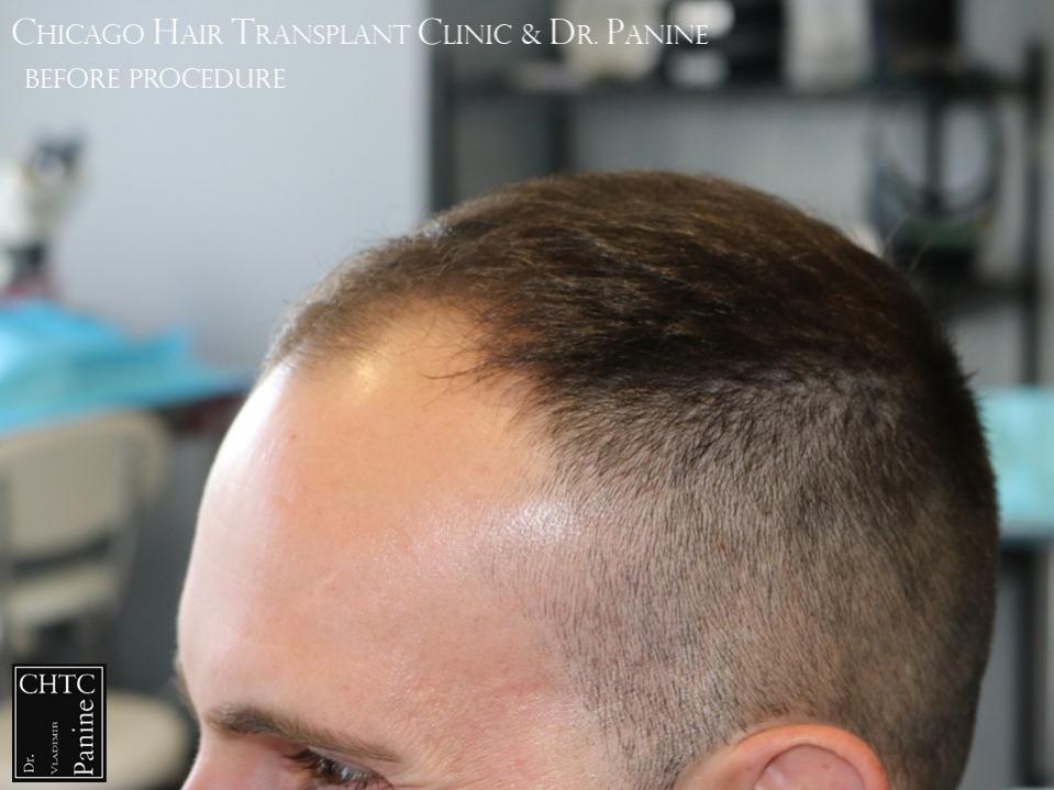 PANINE, MD FUE Hair Transplant Results