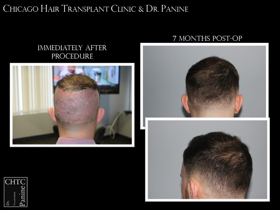 PANINE, MD FUE Hair Transplant Results