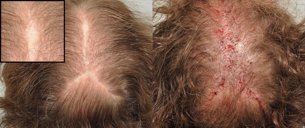Click image for larger version

Name:	Scalp-Reduction-Repair.jpg

Size:	101.3 KB
ID:	36653