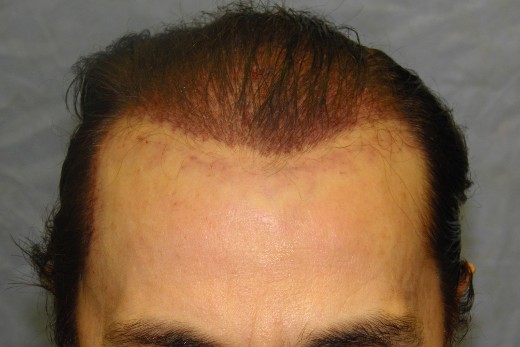 Click image for larger version

Name:	05_recipient-sites-2nd-hair-transplant.jpg

Size:	42.8 KB
ID:	13006