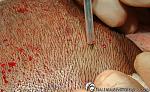 In this Neograft hair transplant case, a 0.8mm limited-depth instrument makes a small 'scoring' incision around the follicle. The grafts can then be...