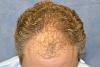 Click image for larger version

Name:	05_before-hair-transplant-top-view.jpg

Size:	58.4 KB
ID:	7412