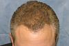 Click image for larger version

Name:	07_after-1st-hair-transplant-top-view.jpg

Size:	49.6 KB
ID:	7414