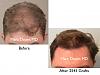 Click image for larger version

Name:	Hair Transplant Slides copy50.001.jpg

Size:	12.5 KB
ID:	46458