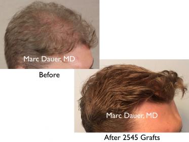 Click image for larger version

Name:	Hair Transplant Slides copy50.003.jpg

Size:	13.4 KB
ID:	46460