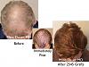 Click image for larger version

Name:	Hair Transplant Slides copy50.004.jpg

Size:	15.4 KB
ID:	46461