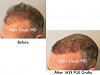Click image for larger version

Name:	Hair Transplant Slides copy13.002.jpg

Size:	12.7 KB
ID:	47553