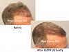 Click image for larger version

Name:	Hair Transplant Slides copy13.003.jpg

Size:	13.6 KB
ID:	47554