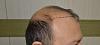Click image for larger version

Name:	Best-FUE-hair-transplant-India (3).jpg

Size:	93.1 KB
ID:	53275
