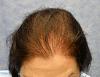 Click image for larger version

Name:	06_before-hair-transplant-top-view.jpg

Size:	61.1 KB
ID:	9853