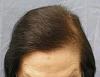 Click image for larger version

Name:	07_after-1st-hair-transplant-top-view.jpg

Size:	50.2 KB
ID:	9854