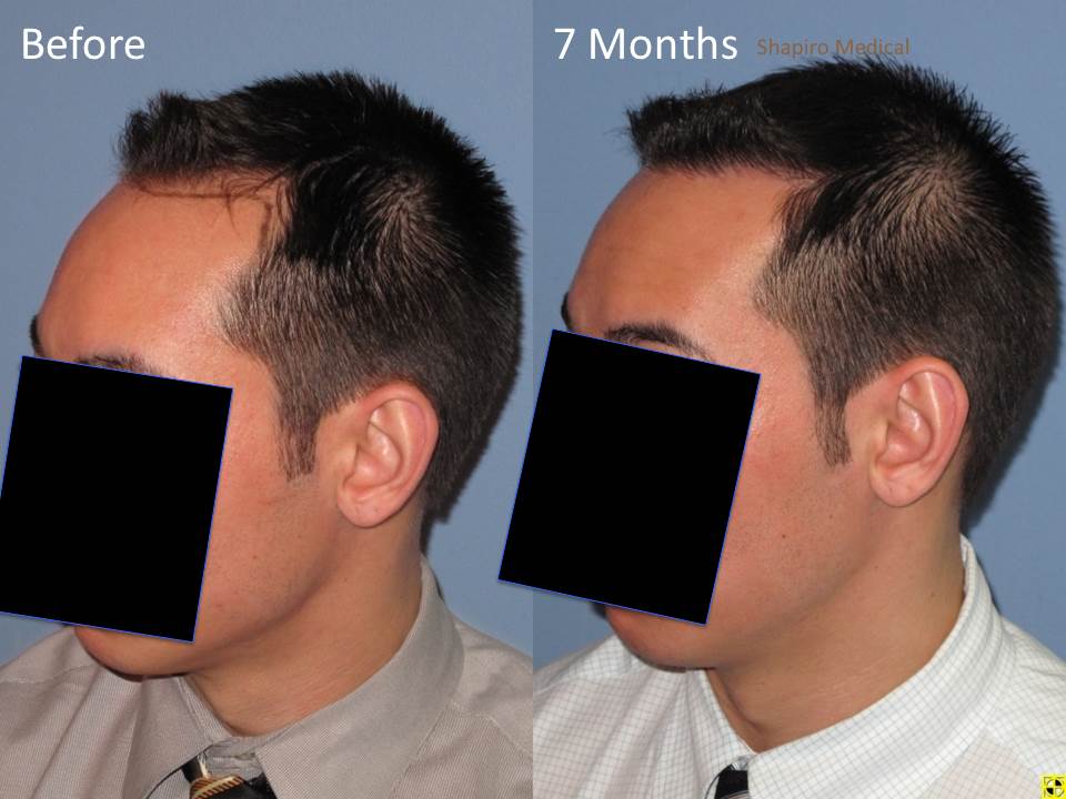 FUE  1578 FU's    7 months post op