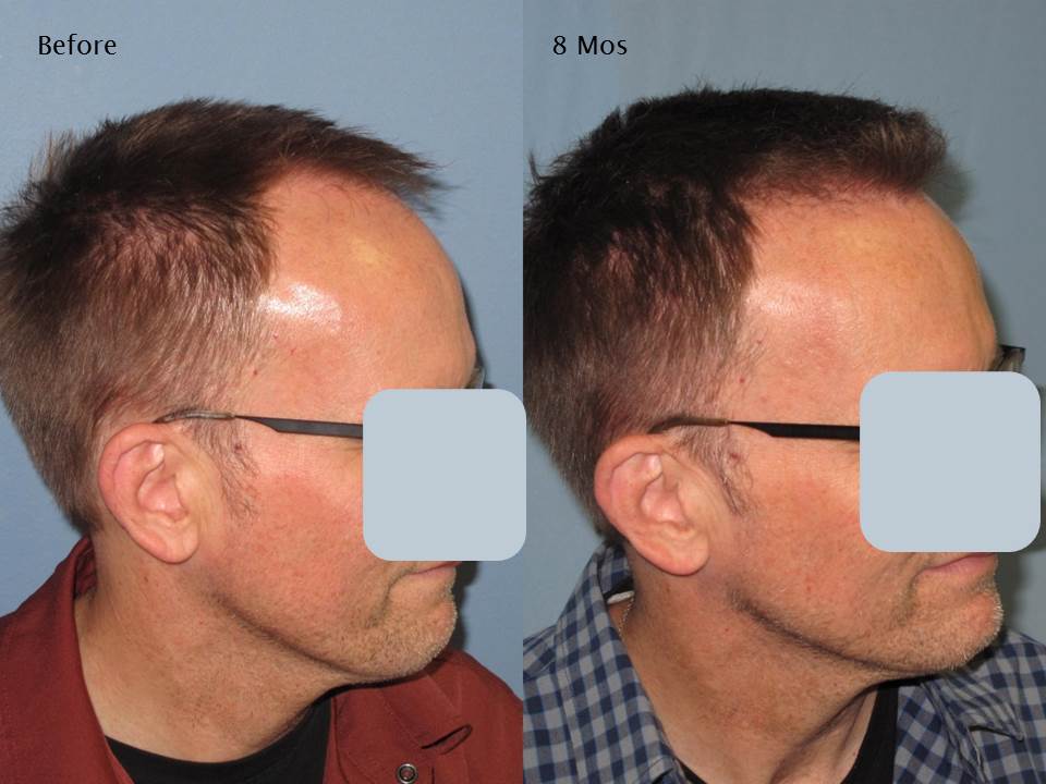 Paul Shapiro, MD 
FUE 2226 grafts 
8 months post op