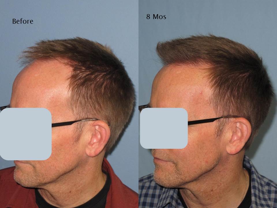 Paul Shapiro, MD 
FUE 2226 grafts 
8 months post op