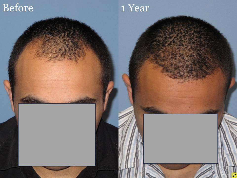 Dr. Paul Shapiro, MD  
Norwood 3A 
2160 grafts 
1 year post op