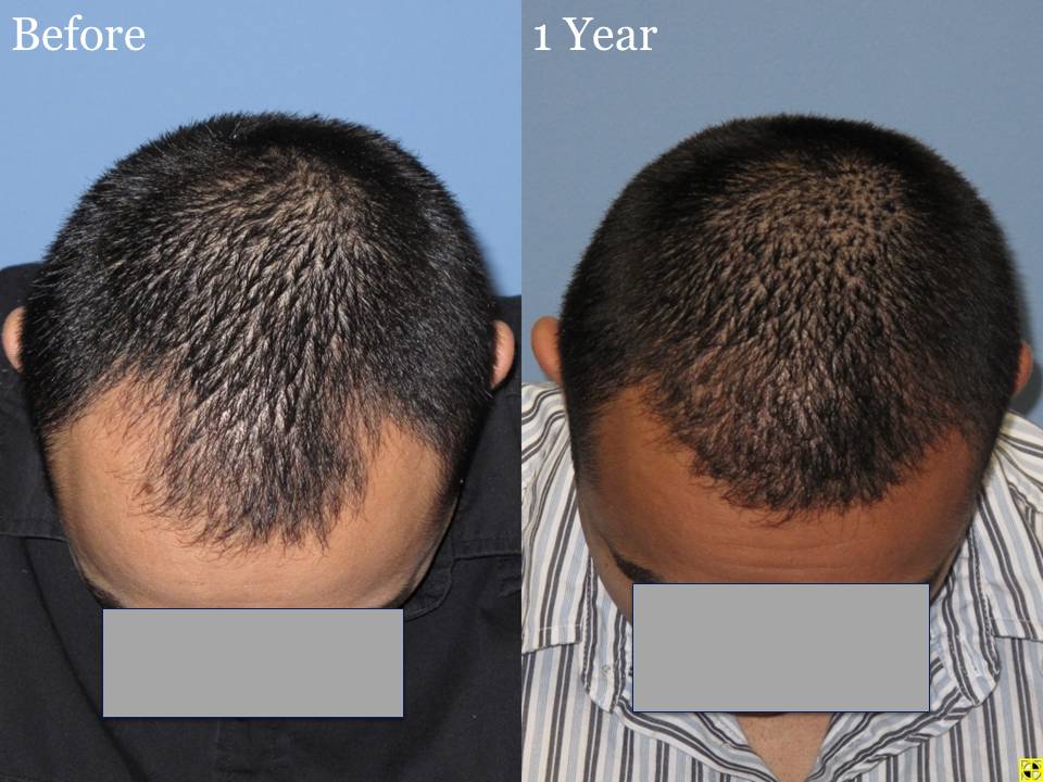 Dr. Paul Shapiro, MD  
Norwood 3A 
2160 grafts 
1 year post op