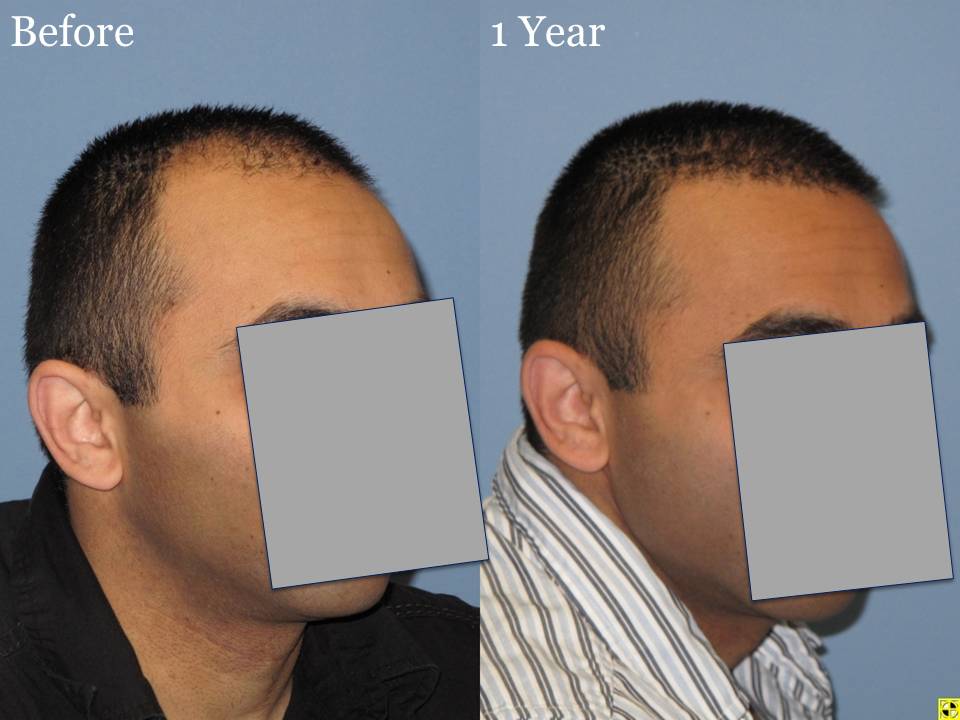 Dr. Paul Shapiro, MD  
Norwood 3A 
2160 grafts 
1 year post op