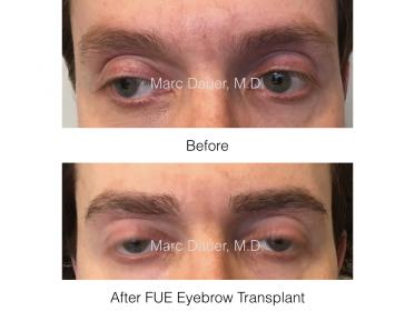 fue eyebrow transplant patient of Dr. Marc Dauer