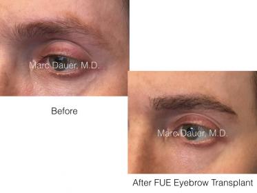 fue eyebrow transplant patient of Dr. Marc Dauer