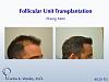 What a difference the 4020 grafts made in this young man's life! 
 
Interactive before/After images may also be viewed here:...
