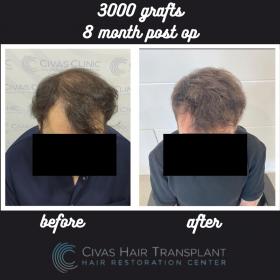 Procedure: FUE Hair Transplant 
Number of grafts: 3000 Grafts 
Results: 8 Months Post-op