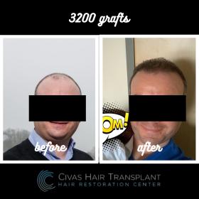 Procedure: FUE Hair Transplant 
Number of grafts: 3200 Grafts