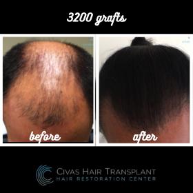 Procedure: FUE Hair Transplant 
Number of grafts: 3200 Grafts