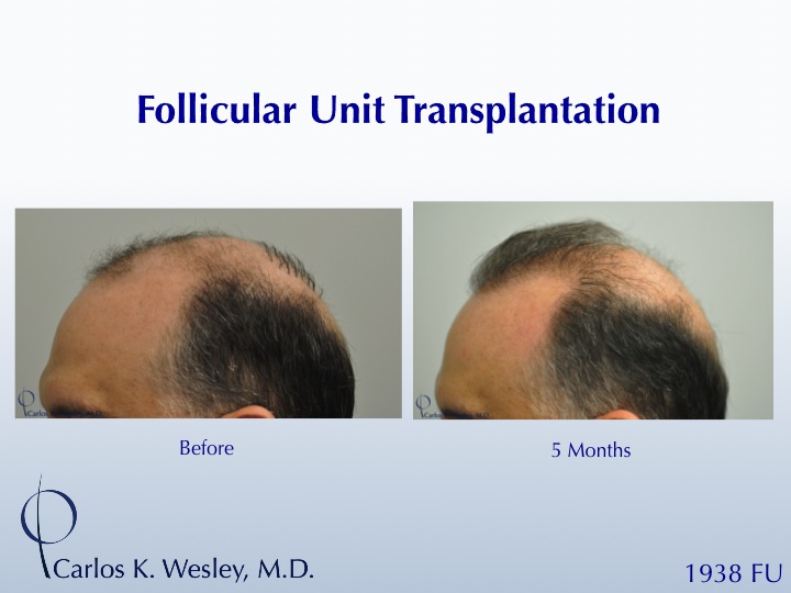 This patient presented to Dr. Carlos K. Wesley for a repair of work performed many years prior at a different clinic.  A video of his transformation...