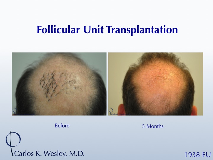 This patient presented to Dr. Carlos K. Wesley for a repair of work performed many years prior at a different clinic.  A video of his transformation...