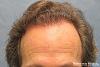 Bernstein Medical's Patient JKJ one year after hair transplant - Detail of Hairline 
 
View his full photoset >>...