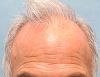 Click image for larger version

Name:	03-before-hairline.jpg

Size:	28.4 KB
ID:	33115