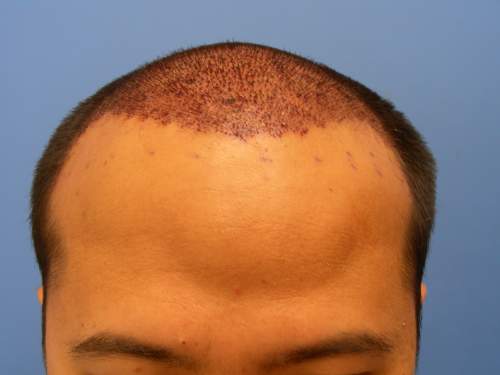 Big lump on my the front of my head, after the procedure this is normal swelling that starts to happen.