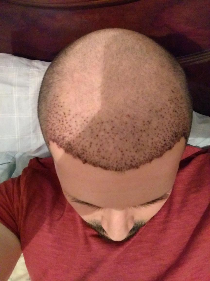 Click image for larger version

Name:	Hairline Fix FUE.jpg

Size:	90.0 KB
ID:	52732