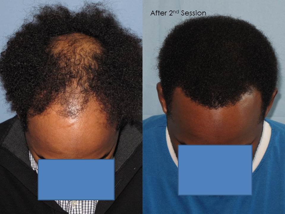 Paul Shapiro, MD 
1st Session FUT = 2339 grafts 
2nd Session FUT = 1706 grafts 
Total for two = 4045 grafts