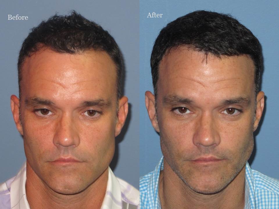 Dr. Paul Shapiro, MD 
FUT 3085 grafts 
12 months post op