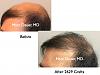 Click image for larger version

Name:	Hair Transplant Slides1.370.jpg

Size:	70.8 KB
ID:	36509