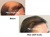 Click image for larger version

Name:	Hair Transplant Slides1.371.jpg

Size:	64.6 KB
ID:	36510