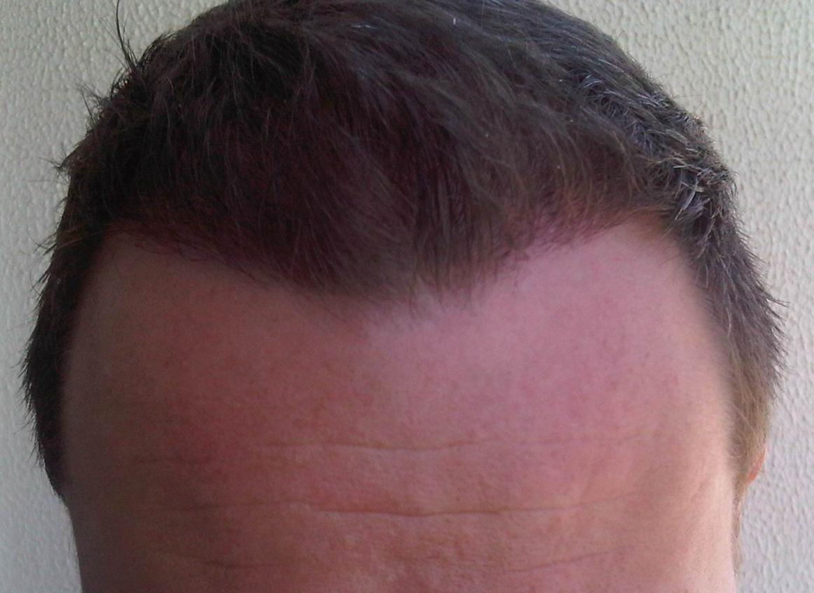 Click image for larger version

Name:	Hairline.jpg

Size:	91.2 KB
ID:	16210