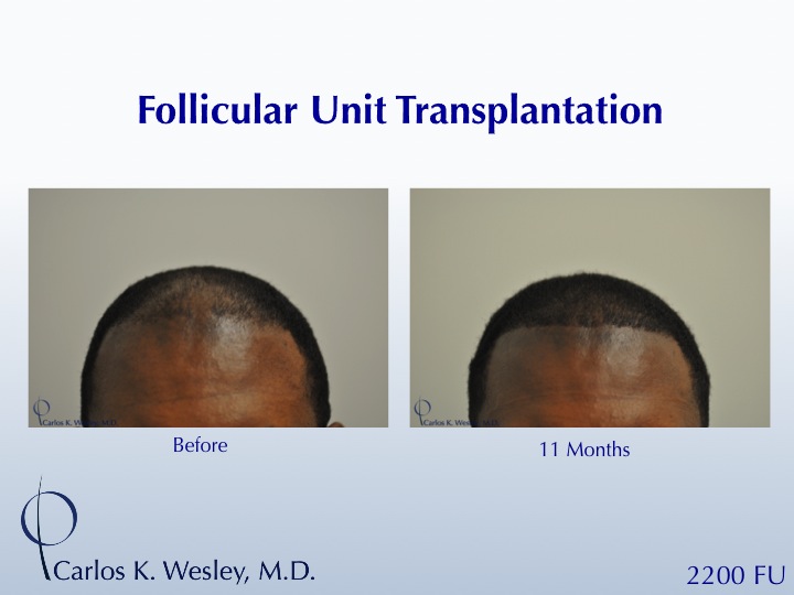 A 35-year-old African-American male underwent a 2200 FU session with Dr. Carlos K. Wesley (NYC).