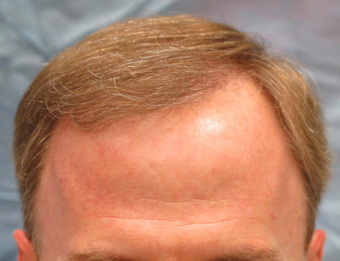 Click image for larger version

Name:	1c_after-hair-transplant_rfr.jpg

Size:	85.5 KB
ID:	47288