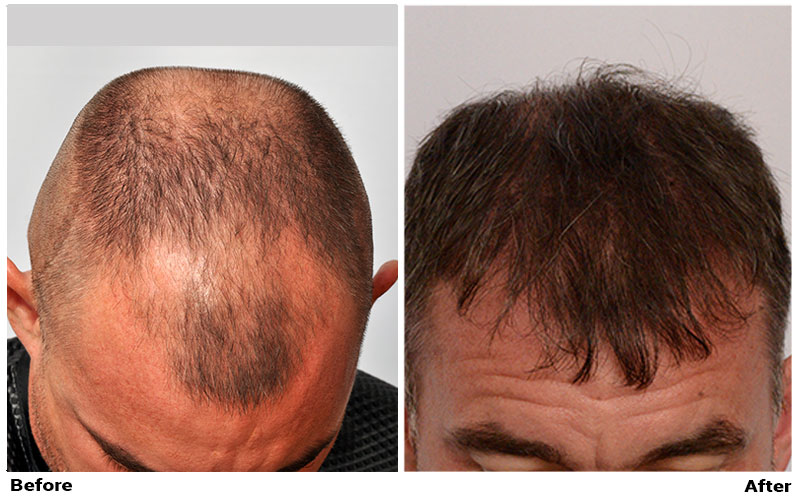 Click image for larger version

Name:	patient-mil-before-after-top-dry2.jpg

Size:	93.7 KB
ID:	57804