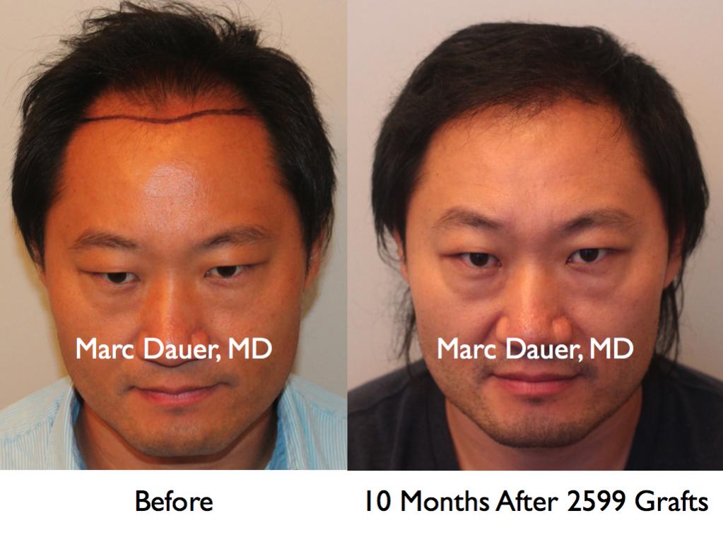 Click image for larger version

Name:	Hair Transplant Slides1.218.jpg

Size:	73.8 KB
ID:	34078