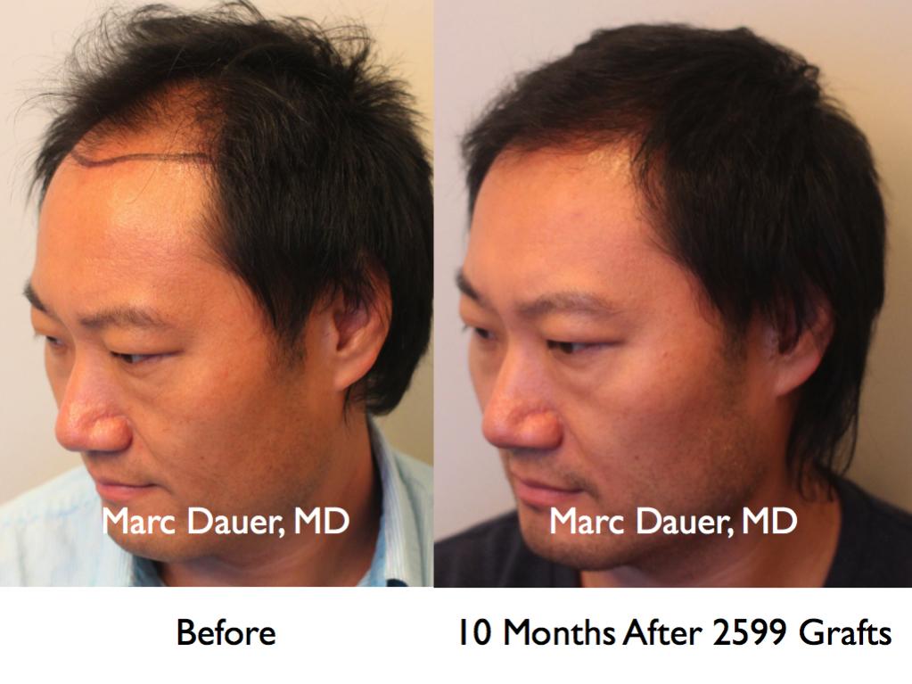 Click image for larger version

Name:	Hair Transplant Slides1.221.jpg

Size:	71.1 KB
ID:	34081