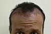 Click image for larger version

Name:	Carlos Miller's Hair Transplant - Post Op (15 of 15).jpg

Size:	30.5 KB
ID:	15539