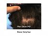 Click image for larger version

Name:	Hair Transplant Slides.429.jpg

Size:	58.3 KB
ID:	36985
